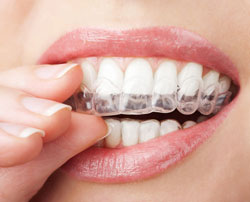 Invisalign - Dentist In Surprise, AZ | John Kim, DDS