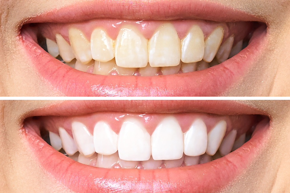 Teeth Whitening - Dentist In Surprise, AZ | John Kim, DDS