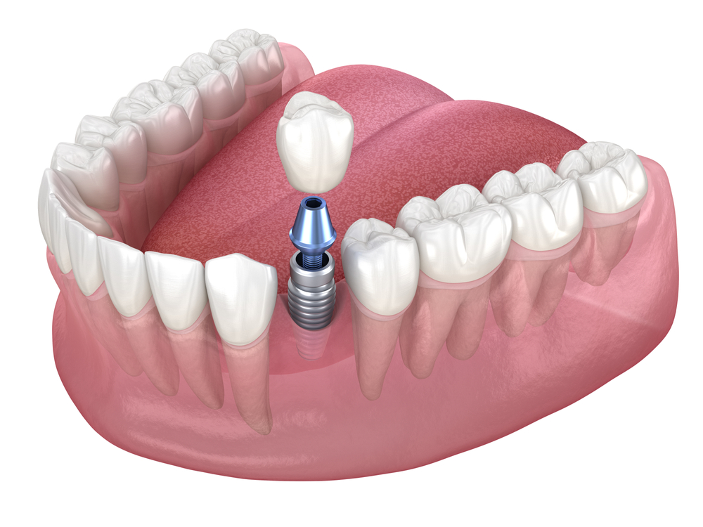 Dental Implants - Dentist In Surprise, AZ | John Kim, DDS